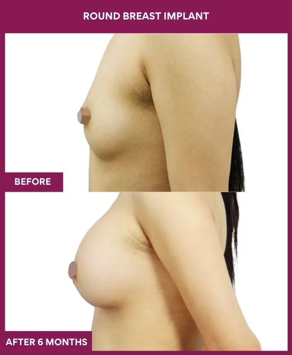 round-breast-implants-before-after-results-mumbai-india-patient04-side-left