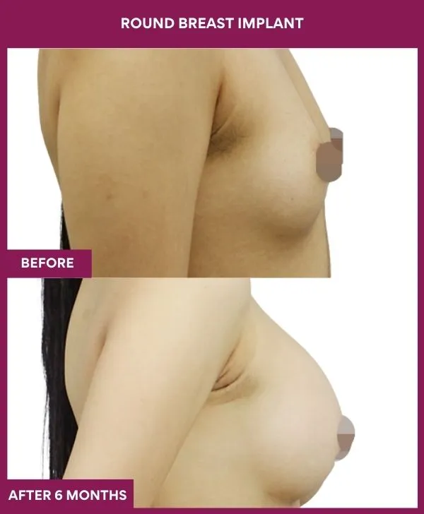 round-breast-implants-before-after-results-mumbai-india-patient04-side-right