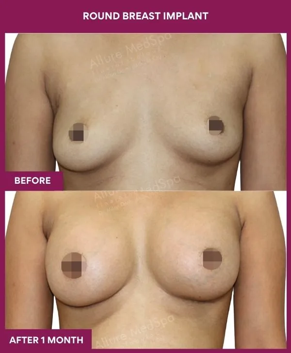 round-breast-implants-before-after-results-mumbai-india-patient05-front