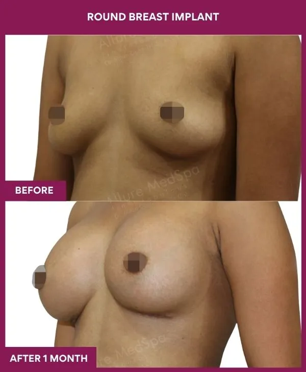 round-breast-implants-before-after-results-mumbai-india-patient05-side-left