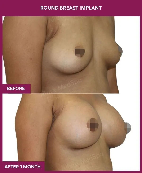 round-breast-implants-before-after-results-mumbai-india-patient05-side-right