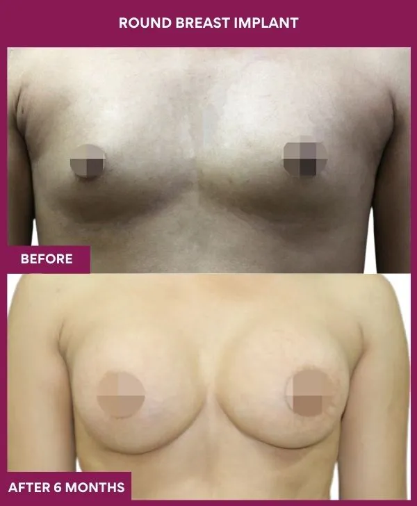 round-breast-implants-before-after-results-mumbai-india-patient06-front
