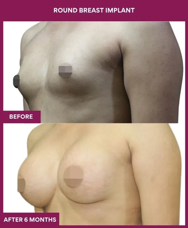 round-breast-implants-before-after-results-mumbai-india-patient06-side-left