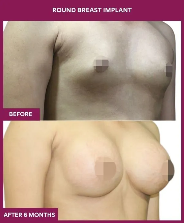 round-breast-implants-before-after-results-mumbai-india-patient06-side-right