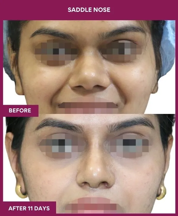saddle-nose-correction-before-after-results-mumbai-india-patient01-front
