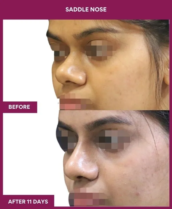 saddle-nose-correction-before-after-results-mumbai-india-patient01-side-left