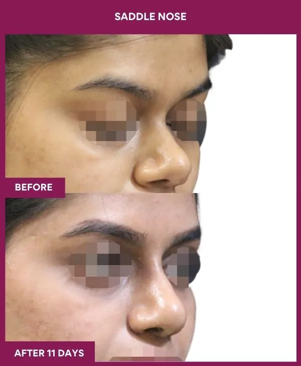 saddle-nose-correction-before-after-results-mumbai-india-patient01-side-right