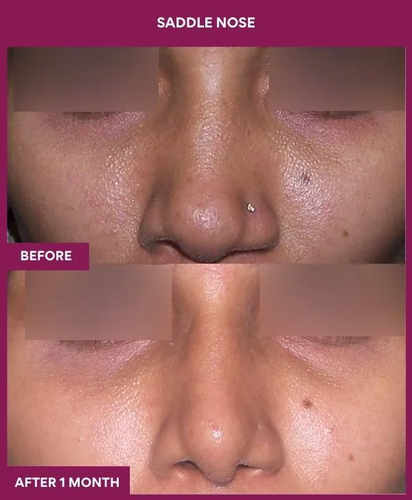 saddle-nose-correction-before-after-results-mumbai-india-patient02-front