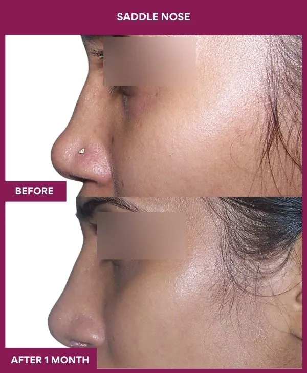 saddle-nose-correction-before-after-results-mumbai-india-patient02-side-left
