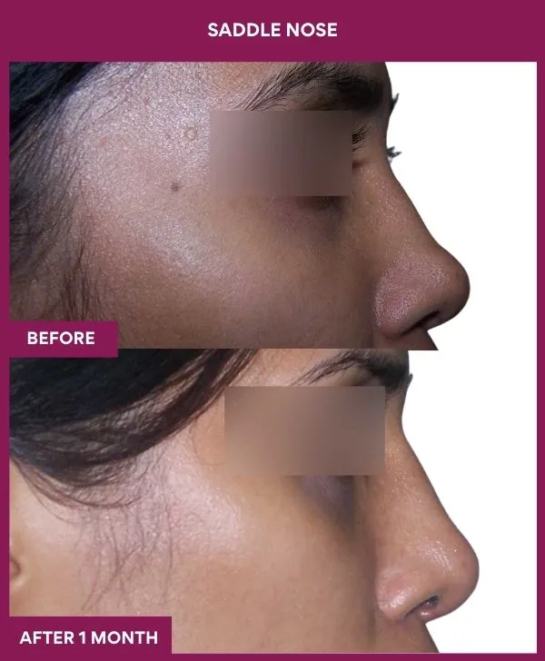 saddle-nose-correction-before-after-results-mumbai-india-patient02-side-right
