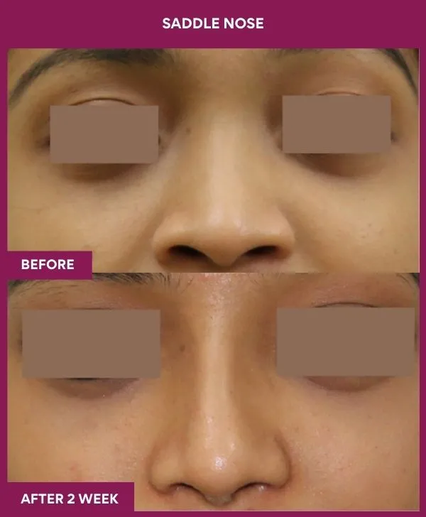 saddle-nose-correction-before-after-results-mumbai-india-patient03-front