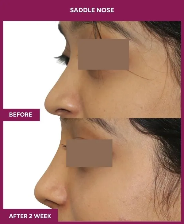saddle-nose-correction-before-after-results-mumbai-india-patient03-side-left