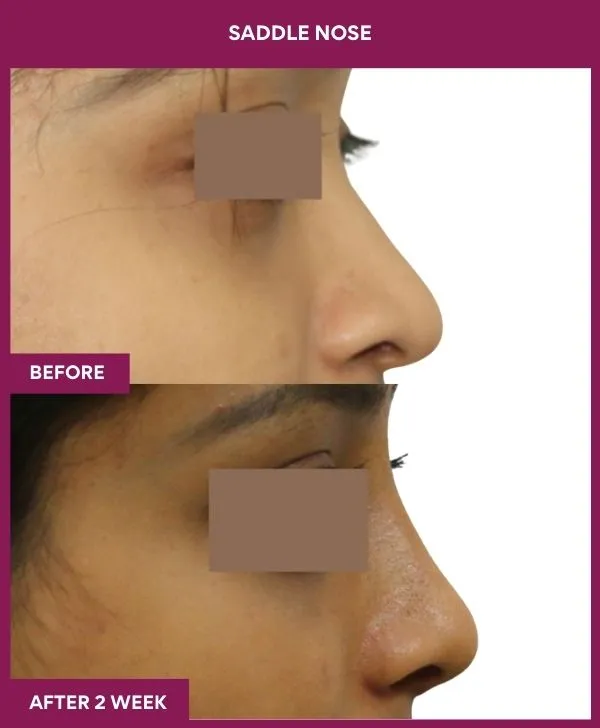 saddle-nose-correction-before-after-results-mumbai-india-patient03-side-right