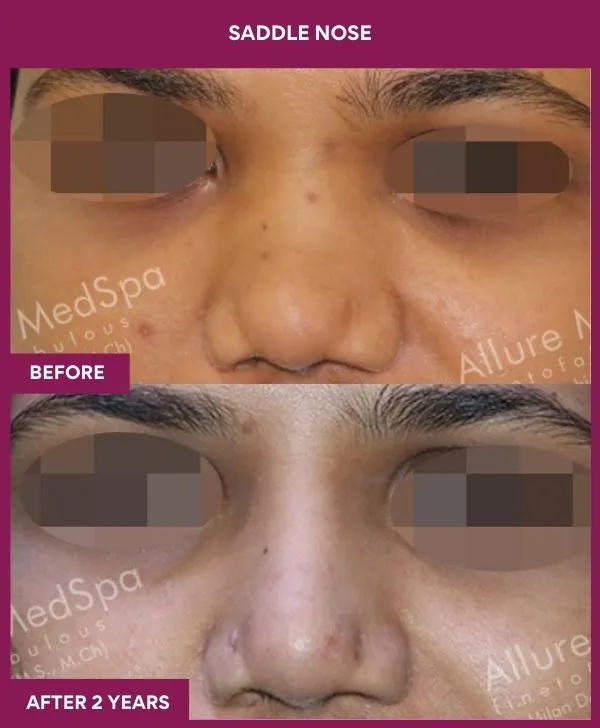 saddle-nose-correction-before-after-results-mumbai-india-patient04-front