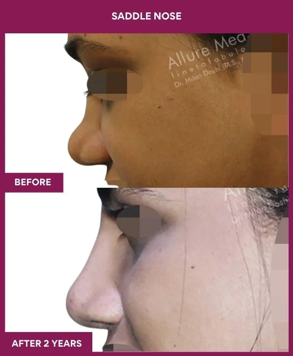 saddle-nose-correction-before-after-results-mumbai-india-patient04-side-left