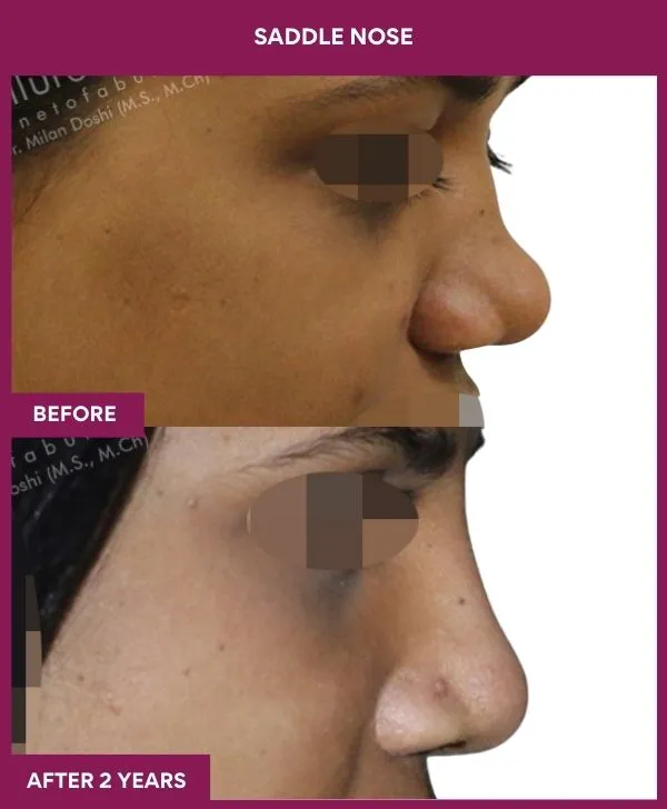 saddle-nose-correction-before-after-results-mumbai-india-patient04-side-right