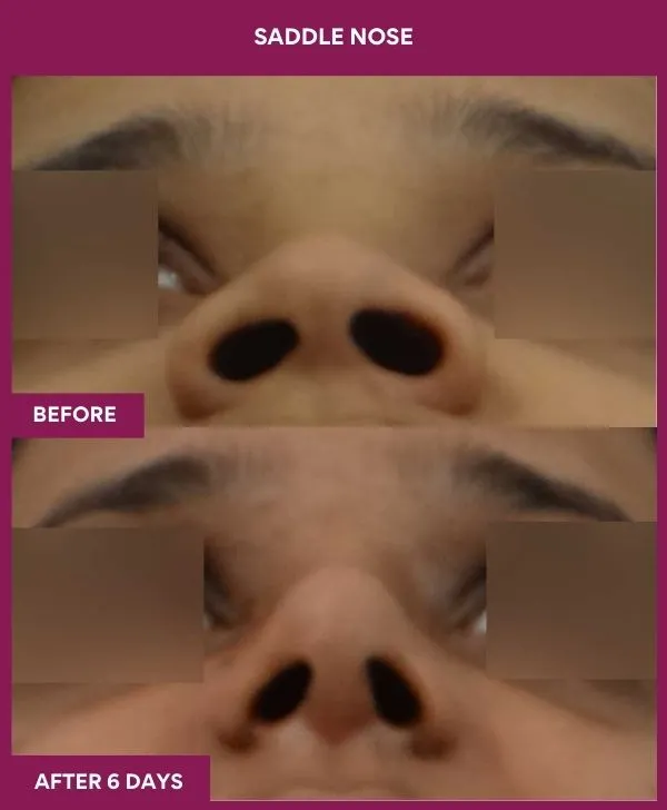saddle-nose-correction-before-after-results-mumbai-india-patient05-front-up