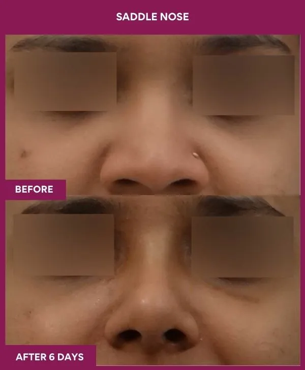 saddle-nose-correction-before-after-results-mumbai-india-patient06-front