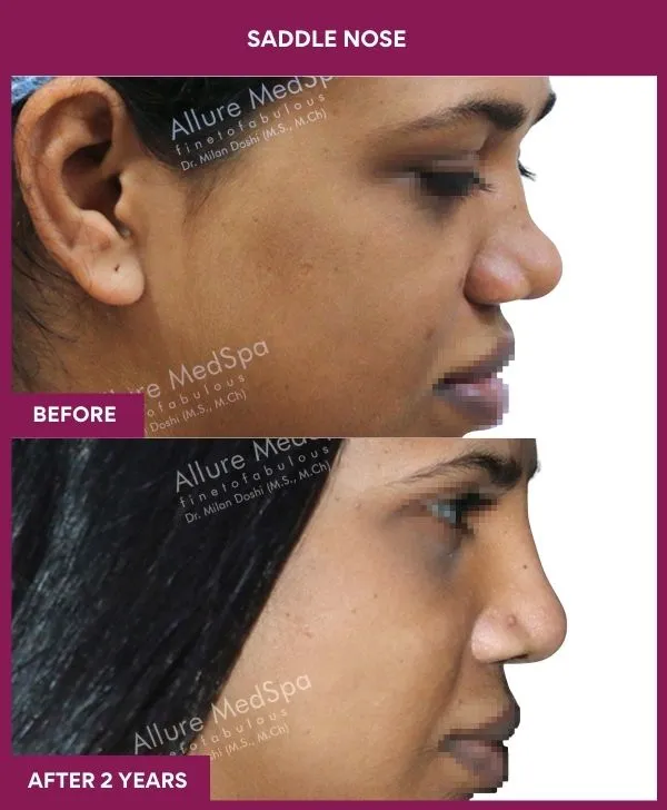 saddle-nose-correction-before-after-results-mumbai-india-patient07-side-right