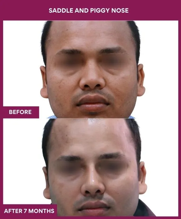 saddle-nose-correction-before-after-results-mumbai-india-patient08-front