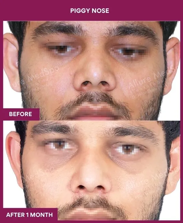 saddle-nose-correction-before-after-results-mumbai-india-patient09-front