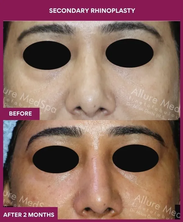 secondary-rhinoplasty-surgery-before-after-results-mumbai-india-patient05-front