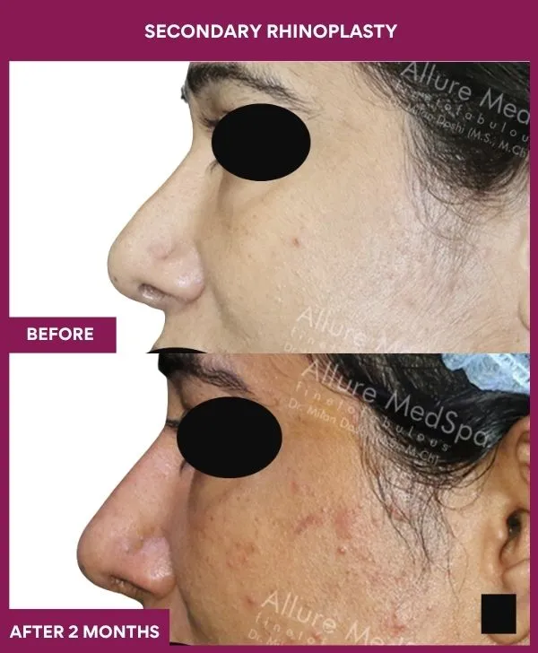 secondary-rhinoplasty-surgery-before-after-results-mumbai-india-patient05-side-left