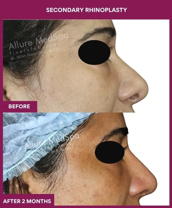 secondary-rhinoplasty-surgery-before-after-results-mumbai-india-patient05-side-right