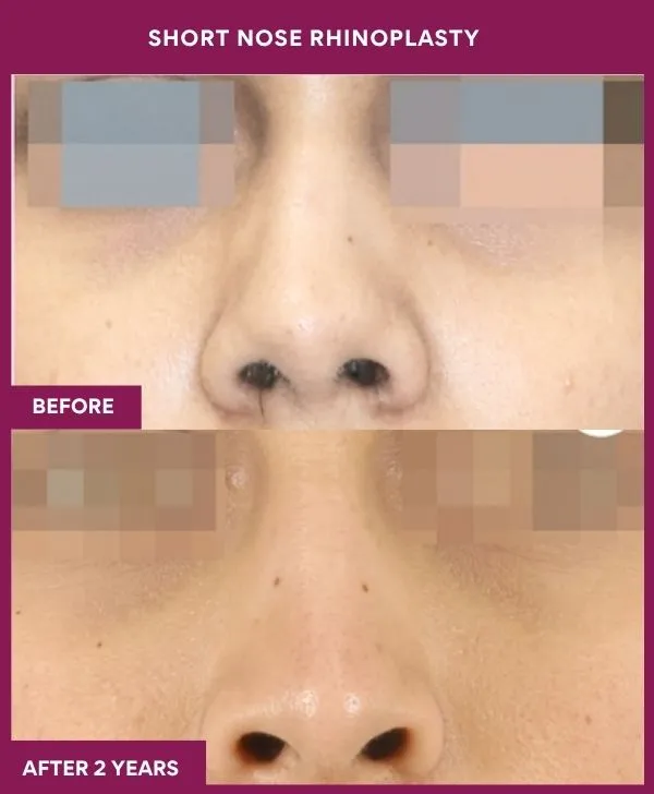 short-nose-rhinoplasty-surgery-before-after-results-mumbai-india-patient01-front