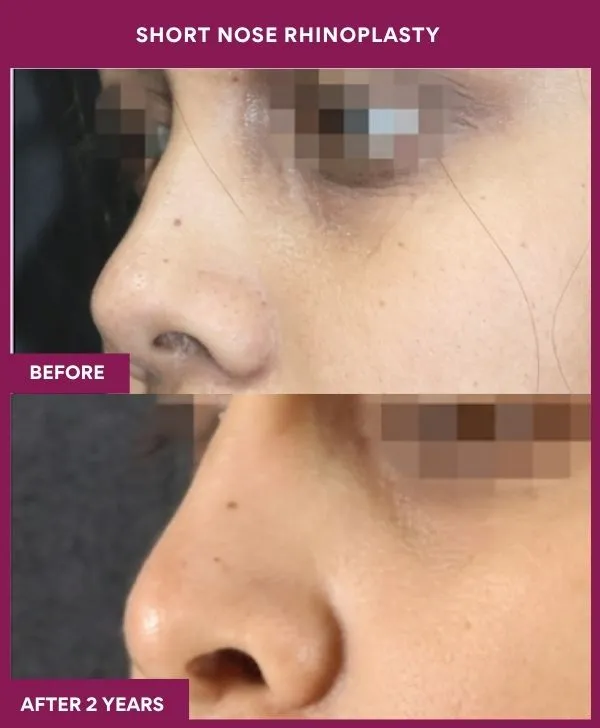 short-nose-rhinoplasty-surgery-before-after-results-mumbai-india-patient01-side-left