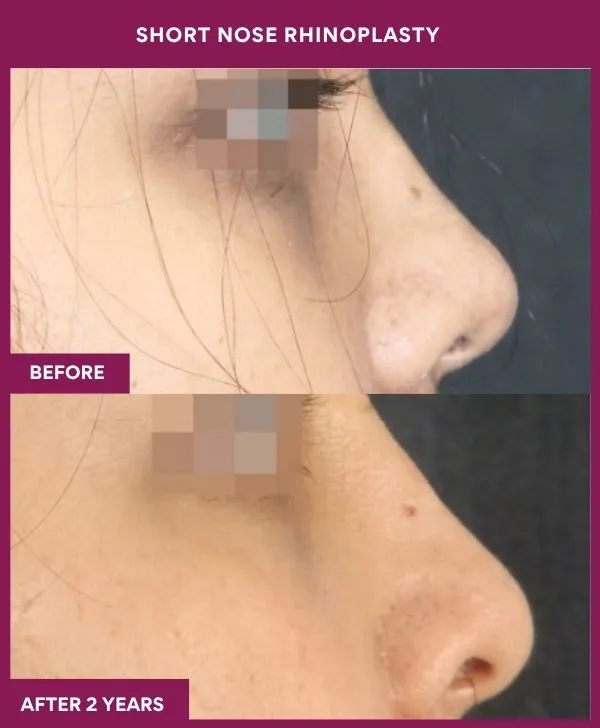 short-nose-rhinoplasty-surgery-before-after-results-mumbai-india-patient01-side-right