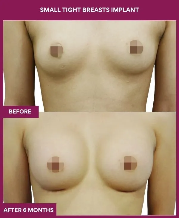 small-breast-implant-before-after-results-mumbai-india-patient01-front