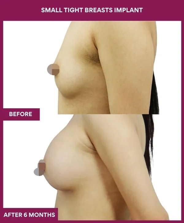 small-breast-implant-before-after-results-mumbai-india-patient01-side-left