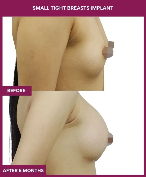 small-breast-implant-before-after-results-mumbai-india-patient01-side-right