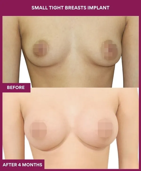 small-breast-implant-before-after-results-mumbai-india-patient02-front