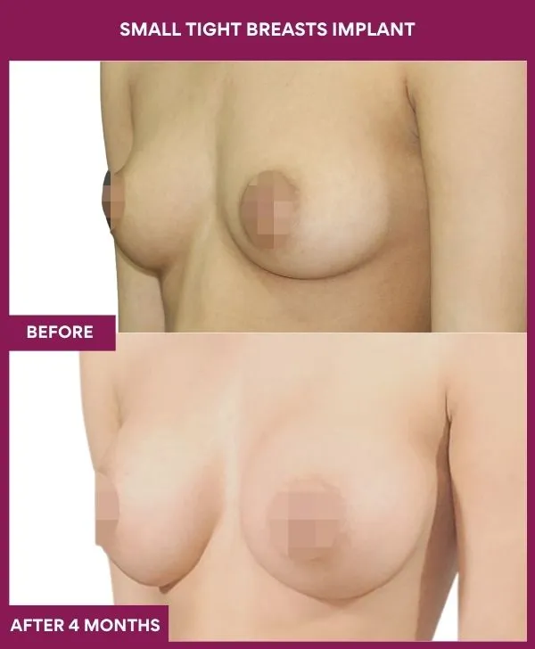 small-breast-implant-before-after-results-mumbai-india-patient02-side-left