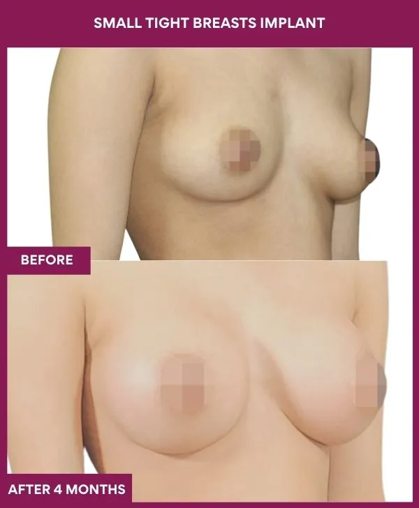 small-breast-implant-before-after-results-mumbai-india-patient02-side-right