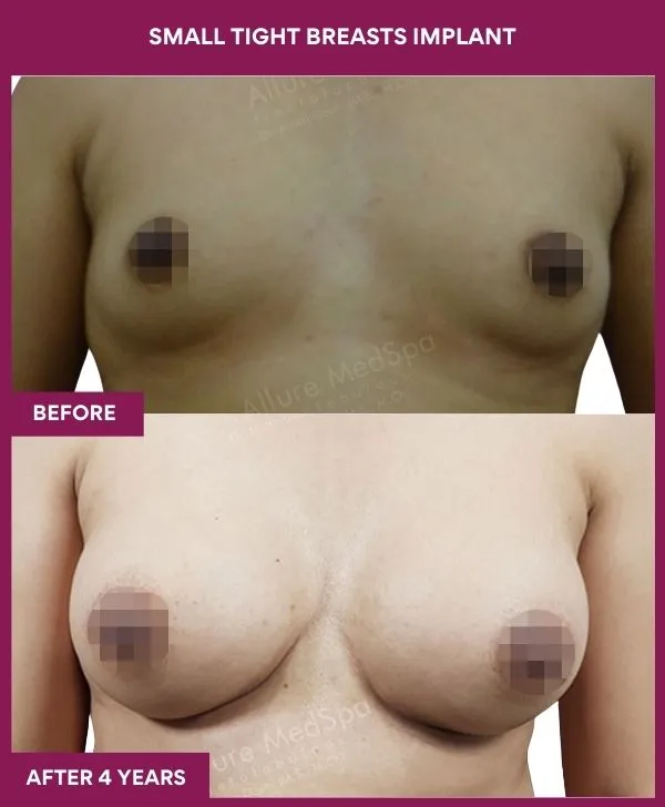 small-breast-implant-before-after-results-mumbai-india-patient03-front