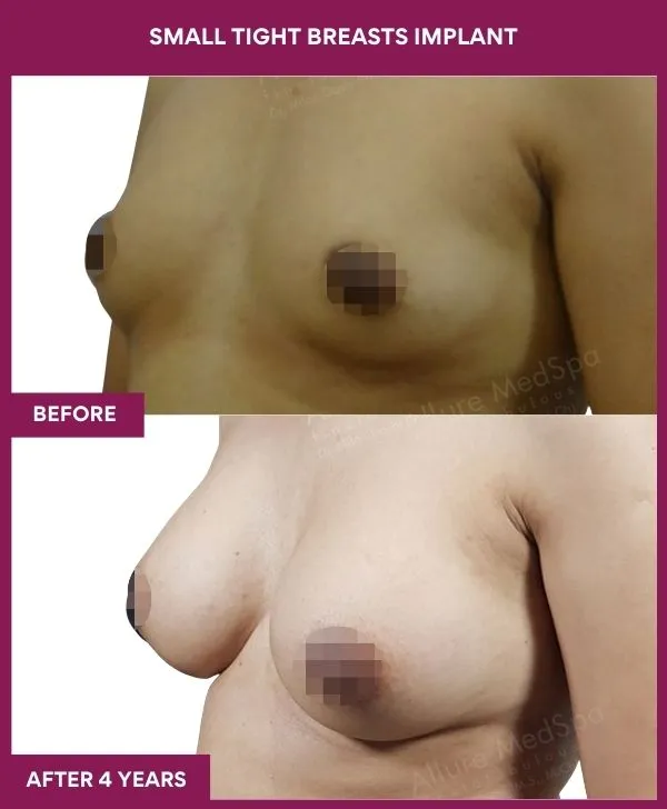 small-breast-implant-before-after-results-mumbai-india-patient03-side-left