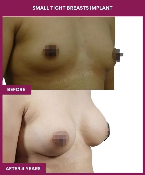 small-breast-implant-before-after-results-mumbai-india-patient03-side-right