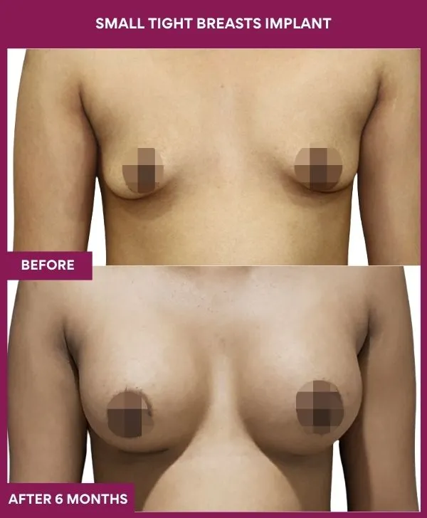 small-breast-implant-before-after-results-mumbai-india-patient04-front