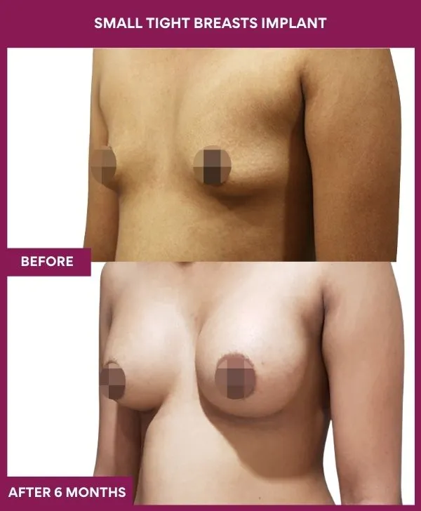 small-breast-implant-before-after-results-mumbai-india-patient04-side-left