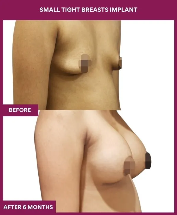 small-breast-implant-before-after-results-mumbai-india-patient04-side-right