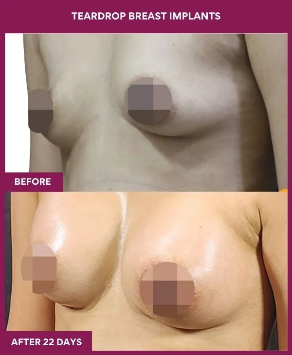 teardrop-breast-implants-before-after-results-mumbai-india-patient01-side-left