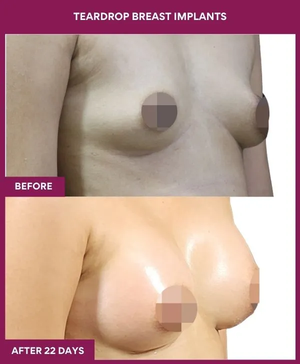 teardrop-breast-implants-before-after-results-mumbai-india-patient01-side-right