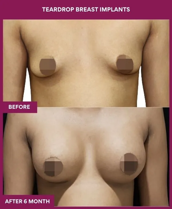teardrop-breast-implants-before-after-results-mumbai-india-patient02-front