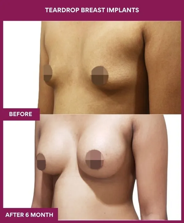 teardrop-breast-implants-before-after-results-mumbai-india-patient02-side-left