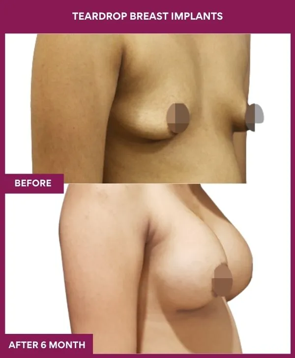 teardrop-breast-implants-before-after-results-mumbai-india-patient02-side-right