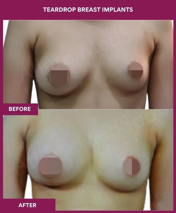 teardrop-breast-implants-before-after-results-mumbai-india-patient03-front