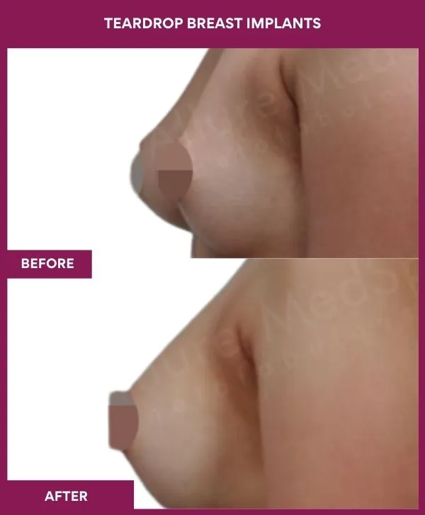 teardrop-breast-implants-before-after-results-mumbai-india-patient03-side-left